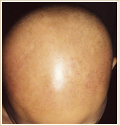 全頭型・汎発（ばんぱつ）円形脱毛症